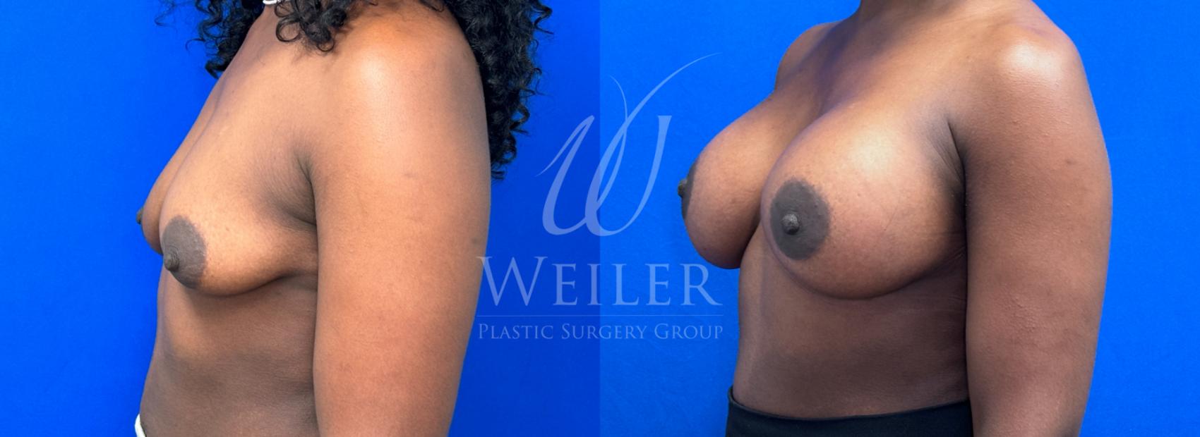 Before & After Breast Augmentation Case 1294 Left Oblique View in Baton Rouge, New Orleans, & Lafayette, Louisiana