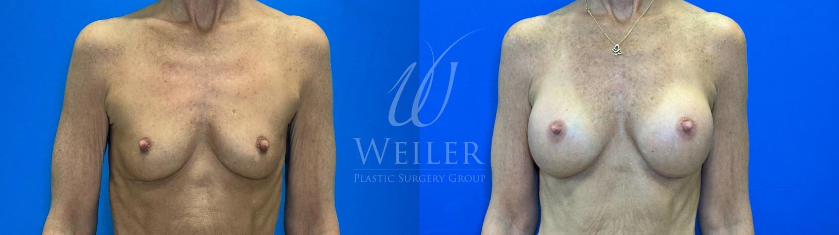 Before & After Breast Augmentation Case 1304 Front View in Baton Rouge, New Orleans, & Lafayette, Louisiana