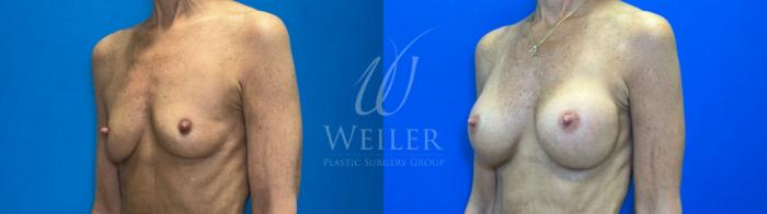 Before & After Breast Augmentation Case 1304 Right Oblique View in Baton Rouge, New Orleans, & Lafayette, Louisiana