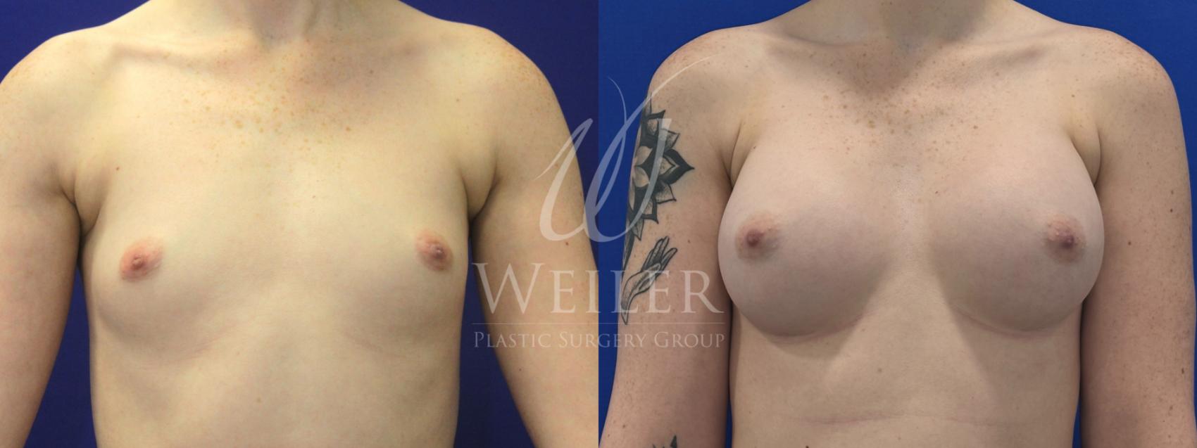 Before & After Breast Augmentation Case 1325 Front View in Baton Rouge, New Orleans, & Lafayette, Louisiana