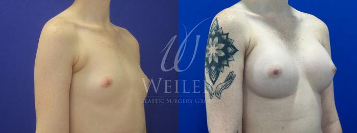 Before & After Breast Augmentation Case 1325 Right Oblique View in Baton Rouge, New Orleans, & Lafayette, Louisiana