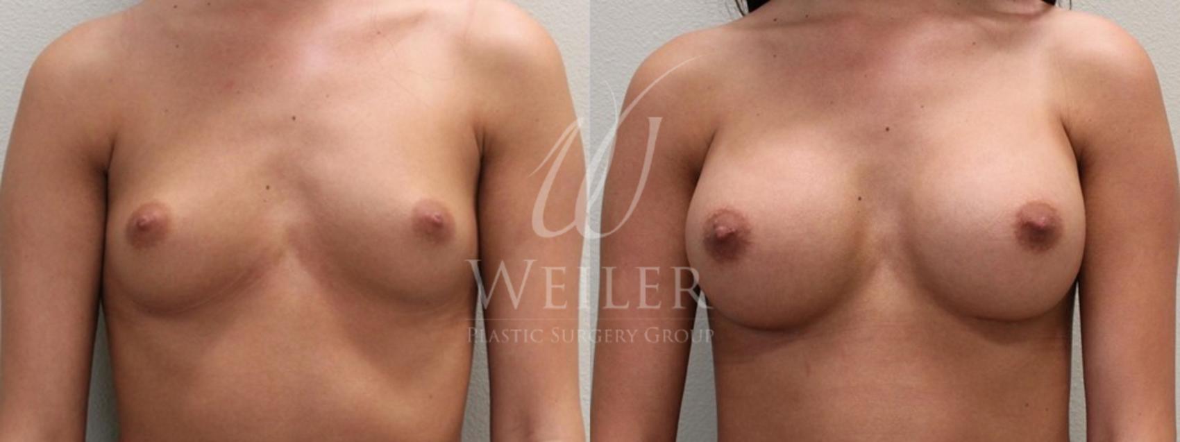 Before & After Breast Augmentation Case 133 View #1 View in Baton Rouge, Louisiana