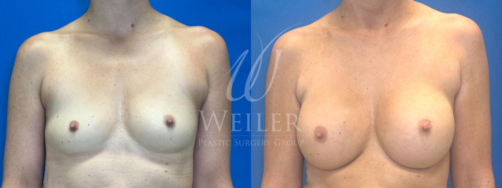 Before & After Breast Augmentation Case 1335 Front View in Baton Rouge, New Orleans, & Lafayette, Louisiana