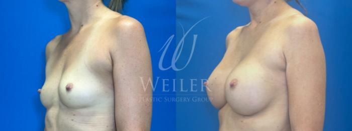 Before & After Breast Augmentation Case 1335 Left Oblique View in Baton Rouge, New Orleans, & Lafayette, Louisiana