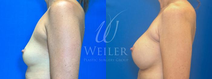 Before & After Breast Augmentation Case 1335 Left Side View in Baton Rouge, New Orleans, & Lafayette, Louisiana