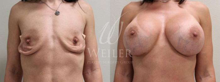 Before & After Breast Augmentation Case 134 View #1 View in Baton Rouge, New Orleans, & Lafayette, Louisiana