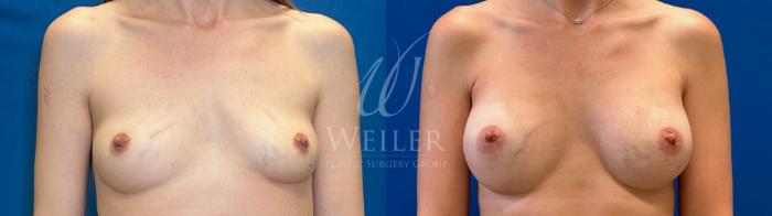 Before & After Breast Augmentation Case 1356 Front View in Baton Rouge, New Orleans, & Lafayette, Louisiana