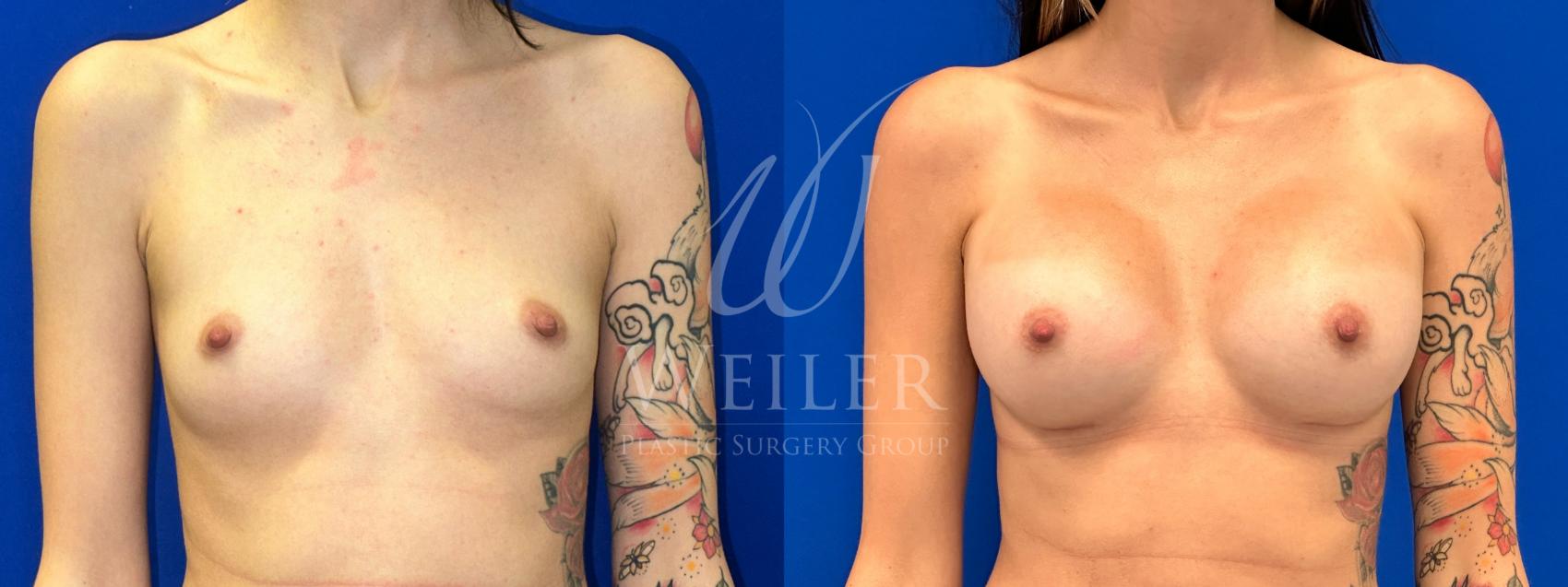 Before & After Breast Augmentation Case 1359 Front View in Baton Rouge, New Orleans, & Lafayette, Louisiana