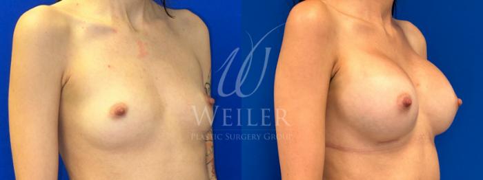 Before & After Breast Augmentation Case 1359 Right Oblique View in Baton Rouge, New Orleans, & Lafayette, Louisiana