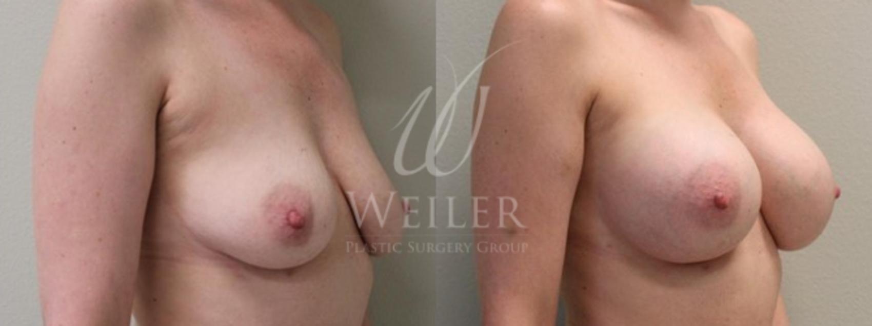 Before & After Breast Augmentation Case 137 View #1 View in Baton Rouge, New Orleans, & Lafayette, Louisiana