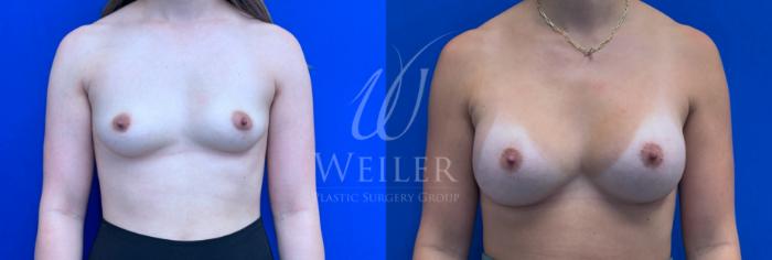 Before & After Breast Augmentation Case 1373 Front View in Baton Rouge, New Orleans, & Lafayette, Louisiana