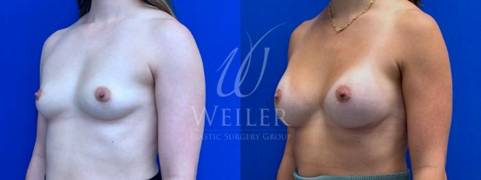 Before & After Breast Augmentation Case 1373 Left Oblique View in Baton Rouge, New Orleans, & Lafayette, Louisiana