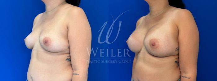 Before & After Breast Augmentation Case 1377 Left Oblique View in Baton Rouge, New Orleans, & Lafayette, Louisiana