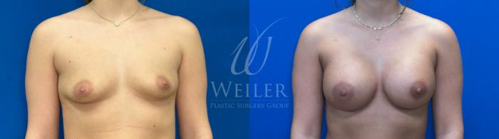 Before & After Breast Augmentation Case 1381 Front View in Baton Rouge, New Orleans, & Lafayette, Louisiana