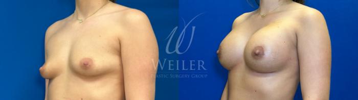 Before & After Breast Augmentation Case 1381 Left Oblique View in Baton Rouge, New Orleans, & Lafayette, Louisiana