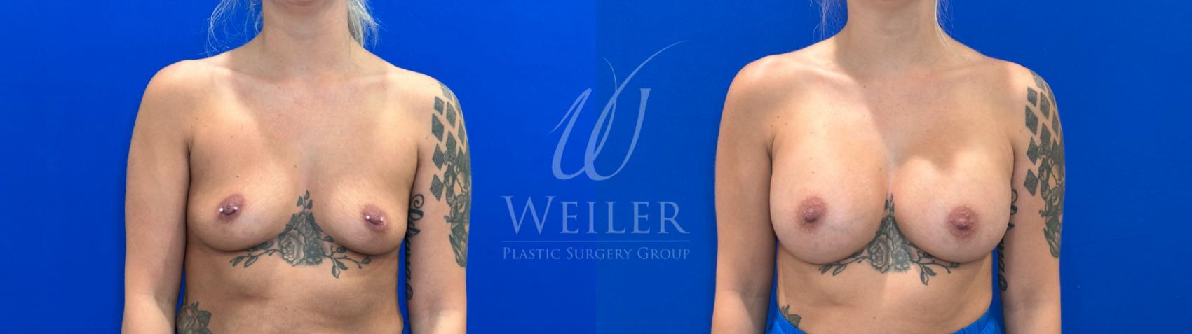 Before & After Breast Augmentation Case 1382 Front View in Baton Rouge, New Orleans, & Lafayette, Louisiana