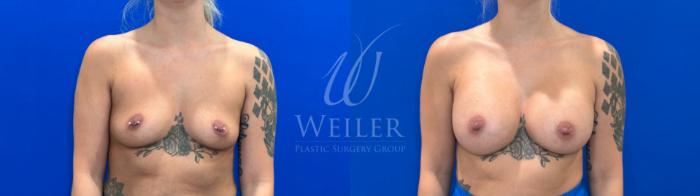 Before & After Breast Augmentation Case 1382 Front View in Baton Rouge, New Orleans, & Lafayette, Louisiana