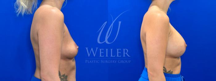 Before & After Breast Augmentation Case 1382 Right Side View in Baton Rouge, New Orleans, & Lafayette, Louisiana