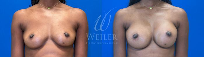 Before & After Breast Augmentation Case 1387 Front View in Baton Rouge, New Orleans, & Lafayette, Louisiana