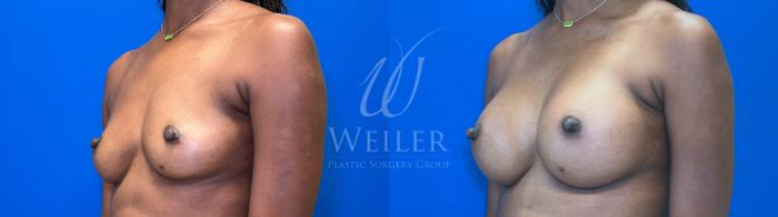 Before & After Breast Augmentation Case 1387 Left Oblique View in Baton Rouge, New Orleans, & Lafayette, Louisiana