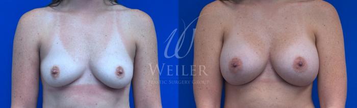 Before & After Breast Augmentation Case 1411 Front View in Baton Rouge, New Orleans, & Lafayette, Louisiana