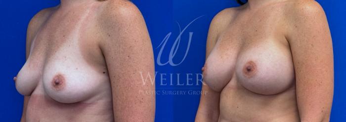 Before & After Breast Augmentation Case 1411 Left Oblique View in Baton Rouge, New Orleans, & Lafayette, Louisiana