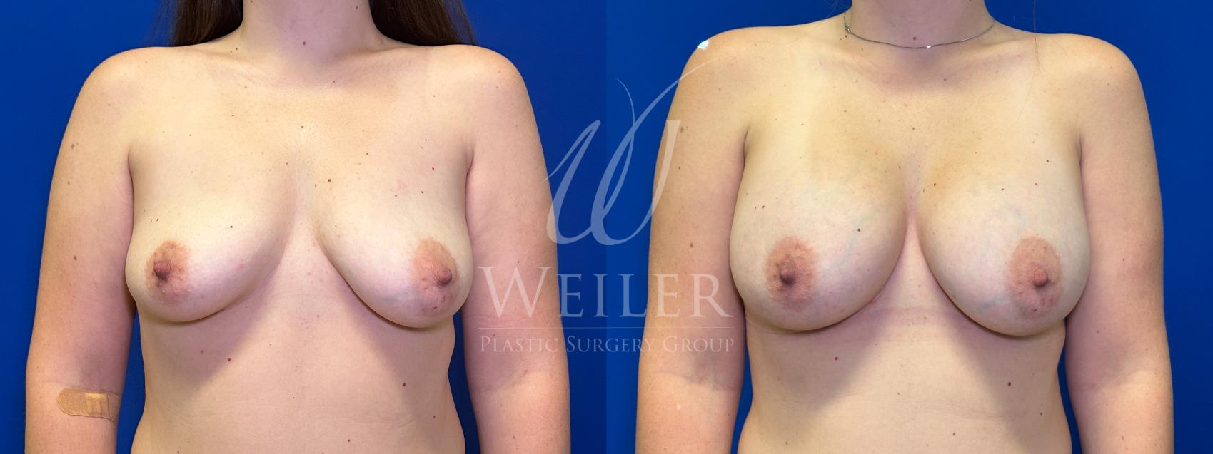 Before & After Breast Augmentation Case 1448 Front View in Baton Rouge, New Orleans, & Lafayette, Louisiana