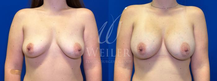 Before & After Breast Augmentation Case 1448 Front View in Baton Rouge, New Orleans, & Lafayette, Louisiana