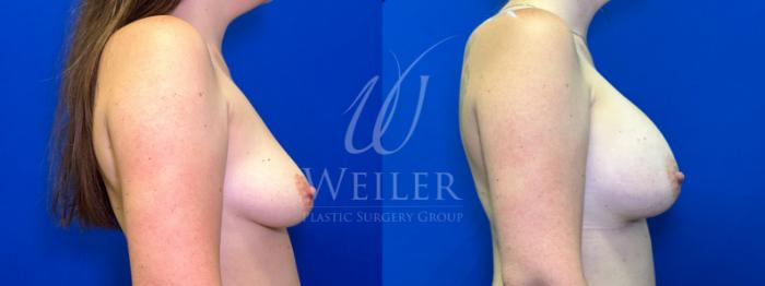 Before & After Breast Augmentation Case 1448 Right Side View in Baton Rouge, New Orleans, & Lafayette, Louisiana