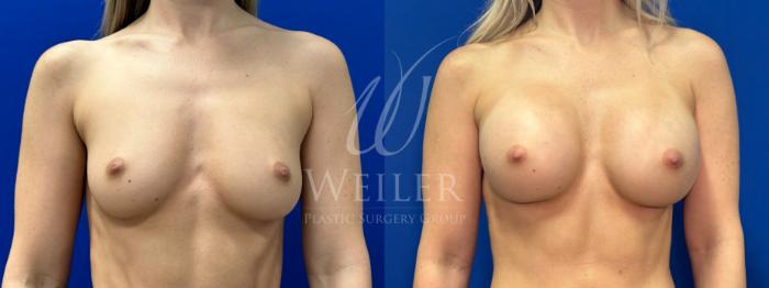 Before & After Breast Augmentation Case 1449 Front View in Baton Rouge, New Orleans, & Lafayette, Louisiana