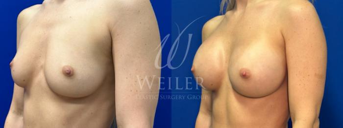 Before & After Breast Augmentation Case 1449 Left Side View in Baton Rouge, New Orleans, & Lafayette, Louisiana