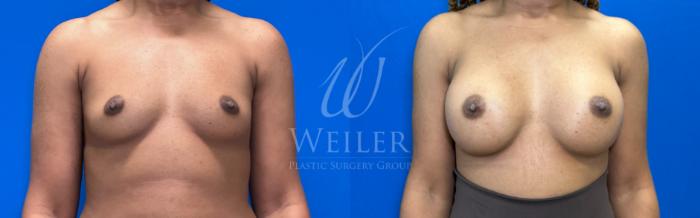 Before & After Breast Augmentation Case 1462 Front View in Baton Rouge, New Orleans, & Lafayette, Louisiana