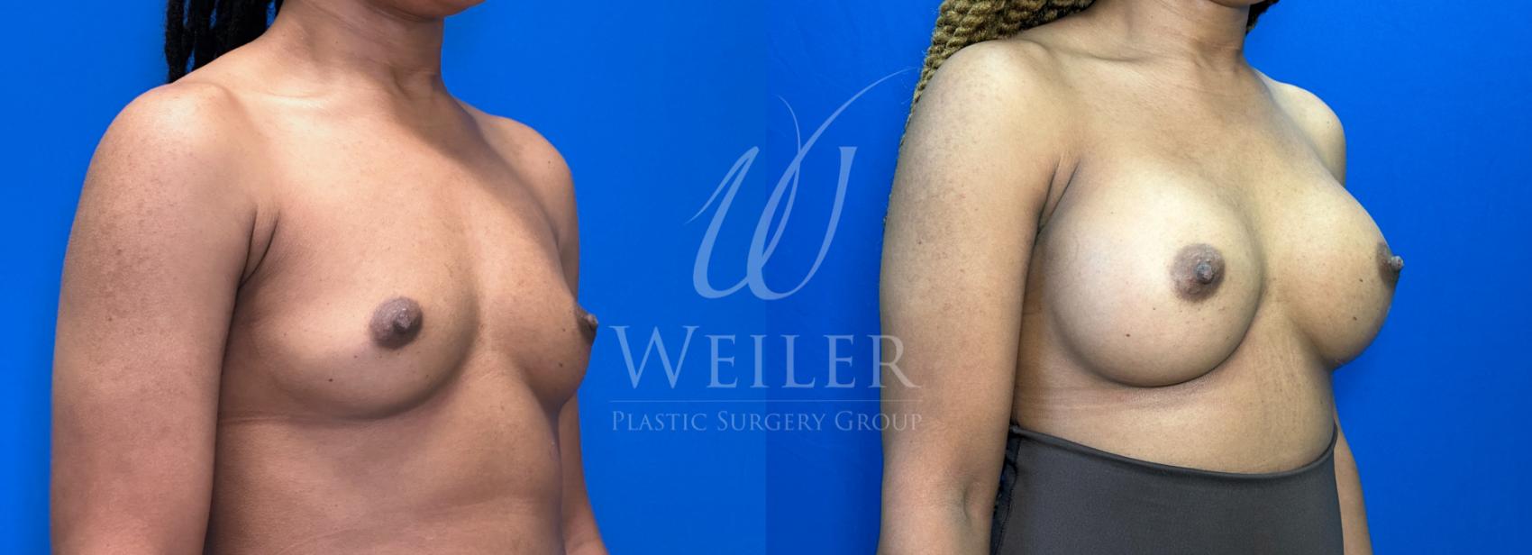 Before & After Breast Augmentation Case 1462 Right Oblique View in Baton Rouge, New Orleans, & Lafayette, Louisiana