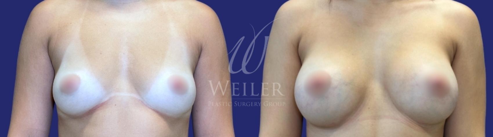Before & After Breast Augmentation Case 1488 Front View in Baton Rouge, New Orleans, & Lafayette, Louisiana