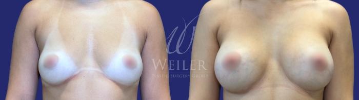 Before & After Breast Augmentation Case 1488 Front View in Baton Rouge, New Orleans, & Lafayette, Louisiana