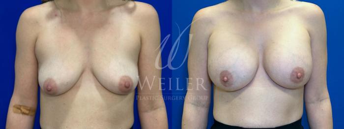 Before & After Breast Augmentation Case 1499 Front View in Baton Rouge, New Orleans, & Lafayette, Louisiana