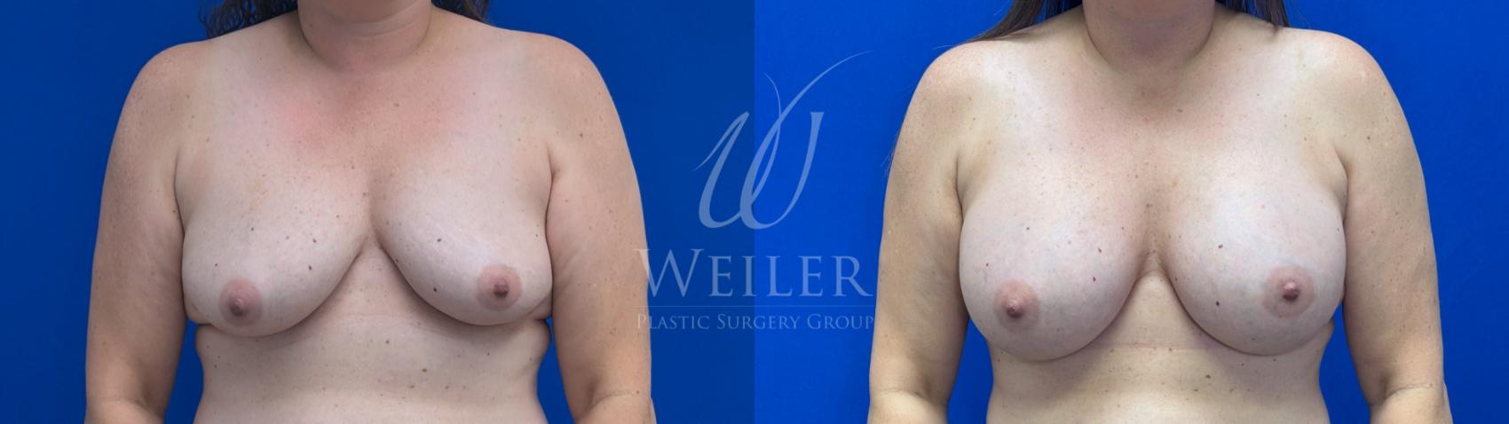 Before & After Breast Augmentation Case 1508 Front View in Baton Rouge, New Orleans, & Lafayette, Louisiana