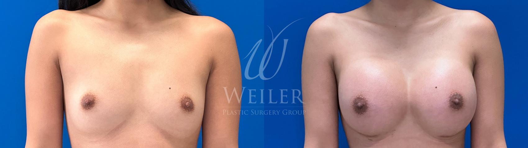 Before & After Breast Augmentation Case 1509 Front View in Baton Rouge, New Orleans, & Lafayette, Louisiana