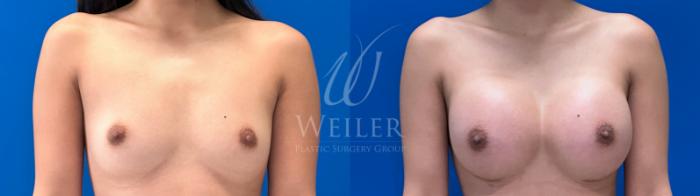 Before & After Breast Augmentation Case 1509 Front View in Baton Rouge, New Orleans, & Lafayette, Louisiana