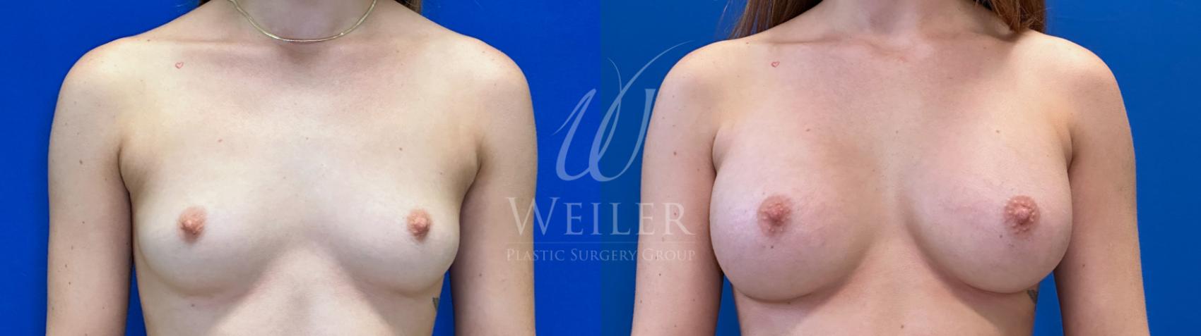 Before & After Breast Augmentation Case 1511 Front View in Baton Rouge, New Orleans, & Lafayette, Louisiana