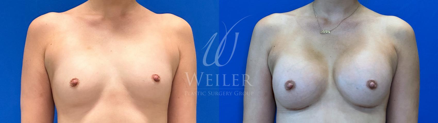 Before & After Breast Augmentation Case 1517 Front View in Baton Rouge, New Orleans, & Lafayette, Louisiana