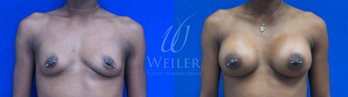 Before & After Breast Augmentation Case 1518 Front View in Baton Rouge, New Orleans, & Lafayette, Louisiana