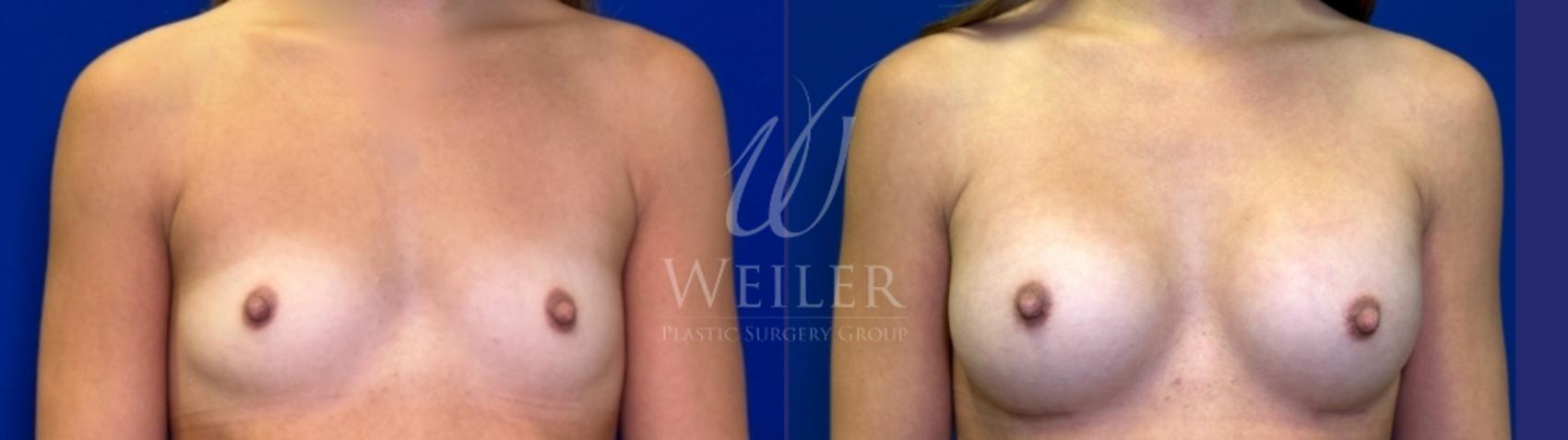 Before & After Breast Augmentation Case 1519 Front View in Baton Rouge, New Orleans, & Lafayette, Louisiana