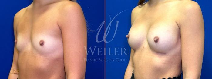 Before & After Breast Augmentation Case 1519 Left Oblique View in Baton Rouge, New Orleans, & Lafayette, Louisiana