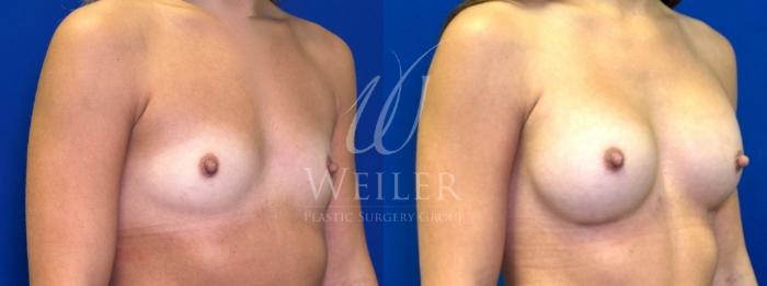Before & After Breast Augmentation Case 1519 Right Oblique View in Baton Rouge, New Orleans, & Lafayette, Louisiana