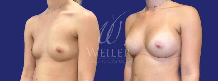 Before & After Breast Augmentation Case 1531 Left Oblique View in Baton Rouge, New Orleans, & Lafayette, Louisiana