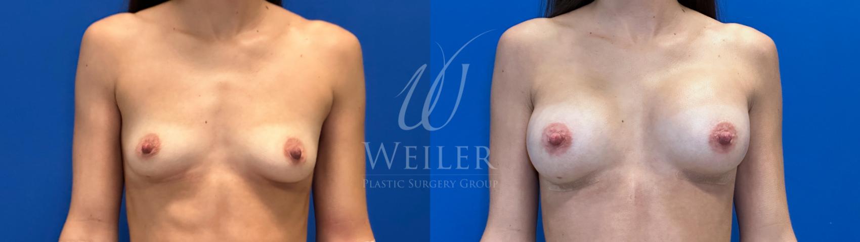Before & After Breast Augmentation Case 1543 Front View in Baton Rouge, New Orleans, & Lafayette, Louisiana