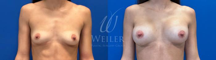 Before & After Breast Augmentation Case 1543 Front View in Baton Rouge, New Orleans, & Lafayette, Louisiana