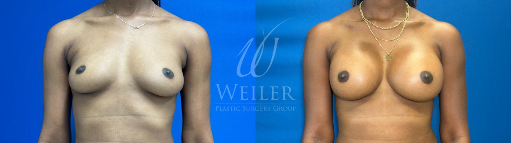 Before & After Breast Augmentation Case 1550 Front View in Baton Rouge, New Orleans, & Lafayette, Louisiana