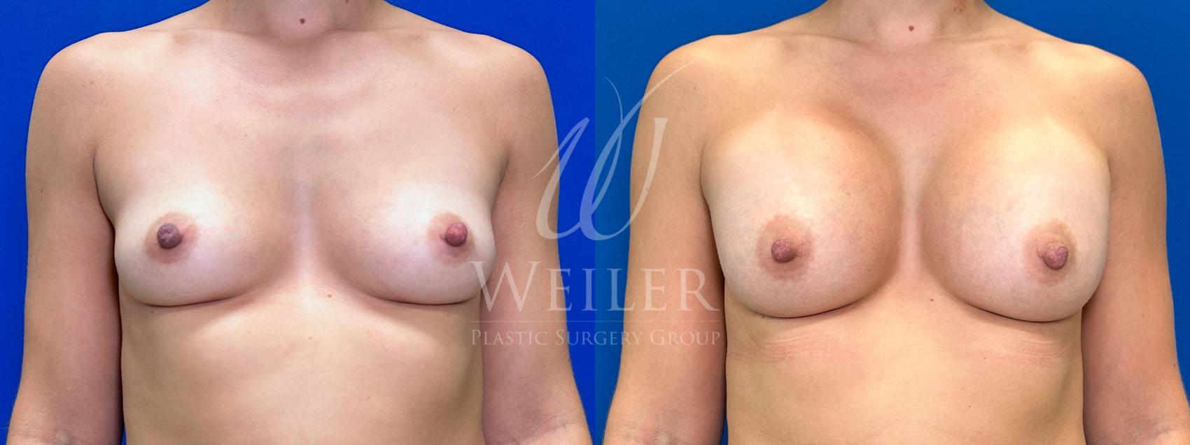Before & After Breast Augmentation Case 1551 Front View in Baton Rouge, New Orleans, & Lafayette, Louisiana